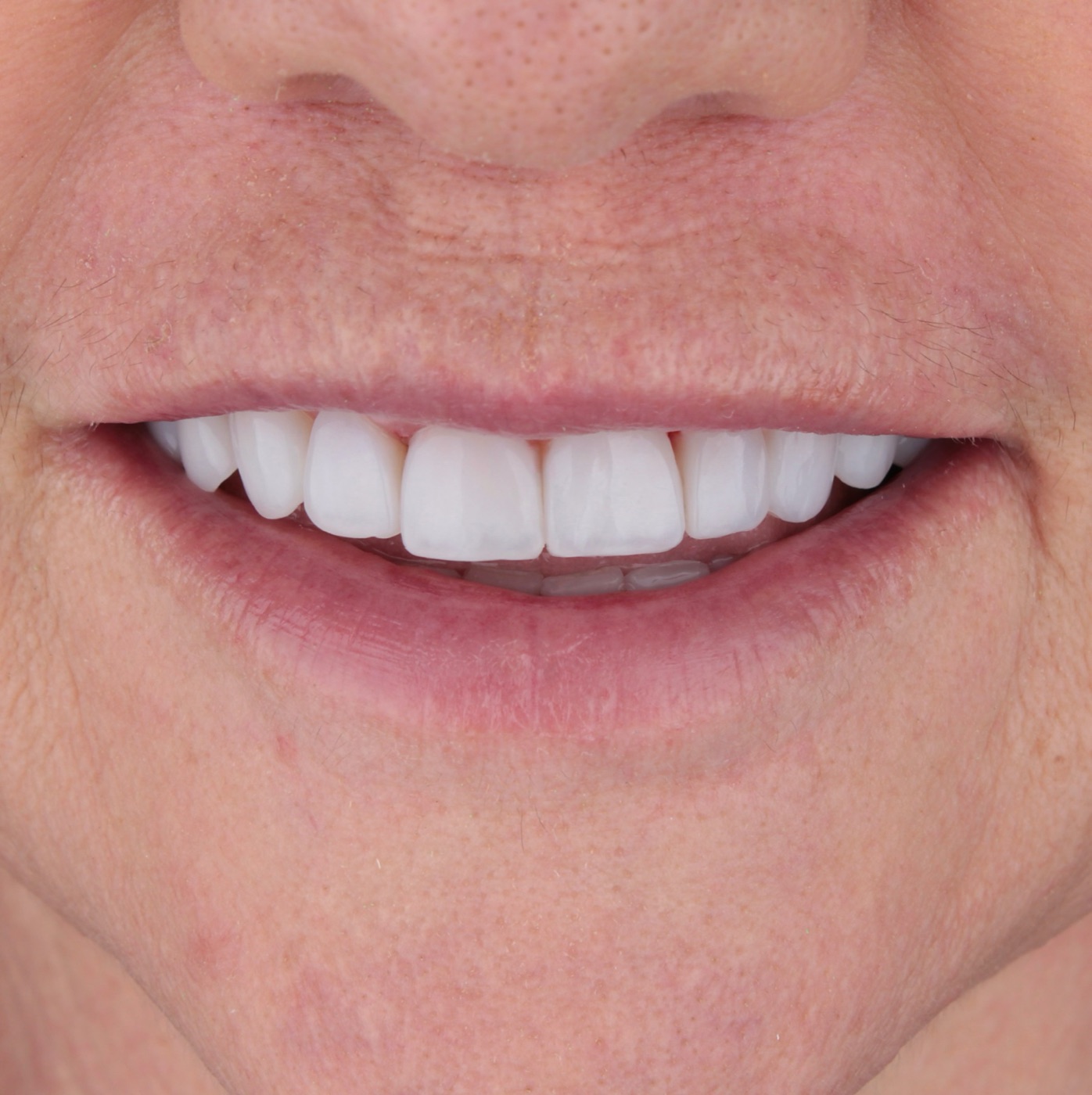Sorriso frontal
