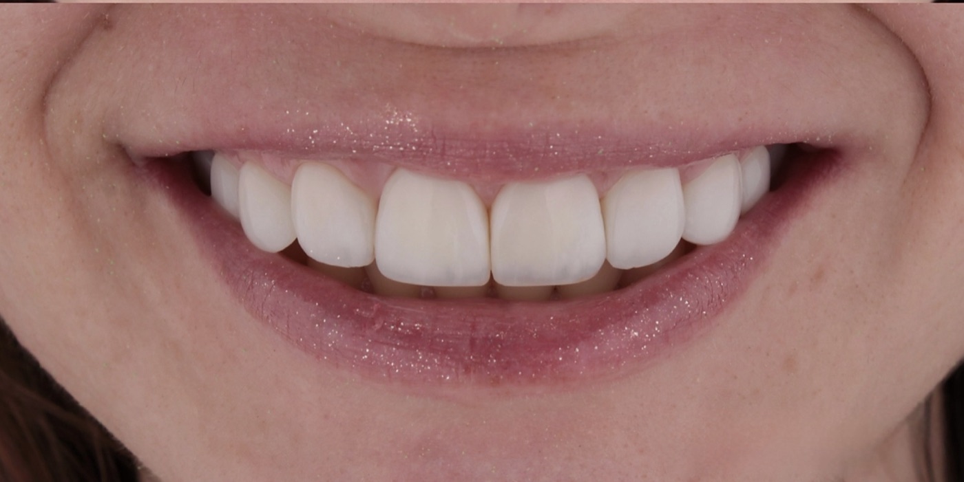 Sorriso depois do tratamento